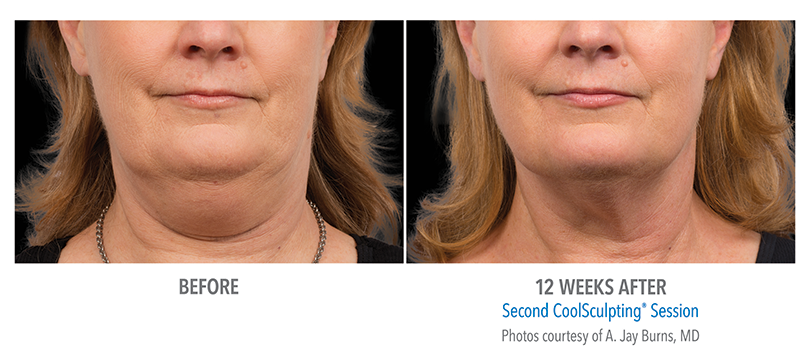 CoolSculpting Double Chin