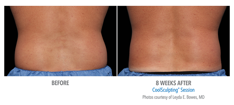 Coolsculpting, Fat Reduction & Cell Removal, Faces of South Tampa, Non-Surgical